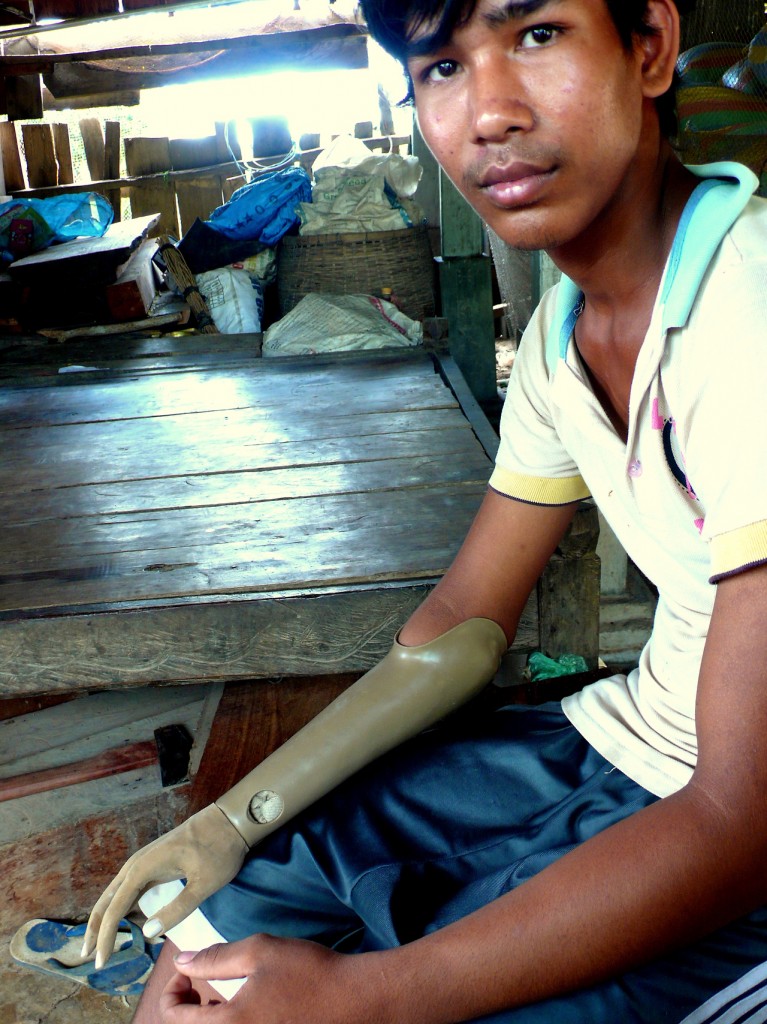 cambodia_amputee_assistance_theropy_470