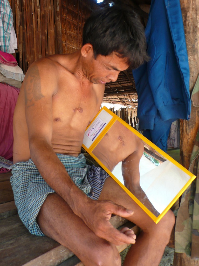 cambodia_amputee_assistance_theropy_475