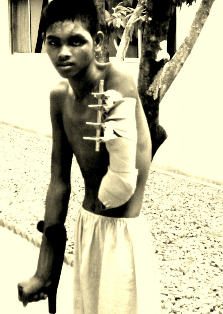 cambodia_amputee_assistance_theropy_635