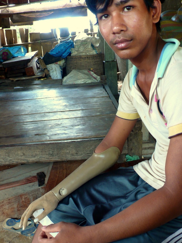 cambodia_amputee_assistance_theropy_650
